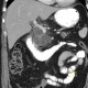 Serous adenoma of pancreas, microcystic: CT - Computed tomography